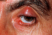Meibomian cyst on eyelid