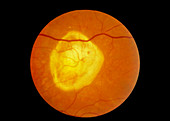 Retinal degeneration