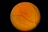 Bear tracks on the retina