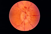 Papilloedema of the eye