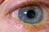 Corneal infection