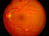 Eye inflammation