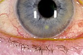Inflamed cornea
