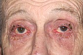 Allergic reaction to glaucoma eye drops