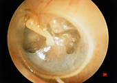 Otitis media of ear