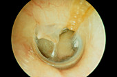 Severe rupture of the eardrum