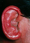 Otitis externa,inflammation of the outer ear