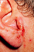 Close-up of an ear with otitis externa in an adult