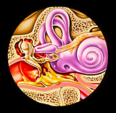 Illustration showing otitis media in middle ear