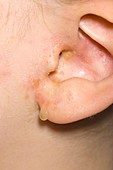 Pus from middle ear infection