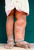 Legs of man with filariasis,elephantiasis