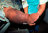 Swollen leg of elephantiasis patient