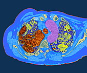 Lung fibrosis,CT scan