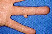 Fibroma on finger