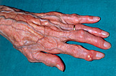 Gouty tophi: clinical photograph of hand