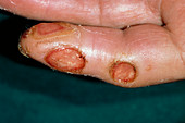 Gout: ulcerated tophi on a patient's finger
