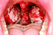 Tonsils of person with glandular fever
