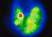 Coloured Gamma Scan of goitre of the thyroid gland