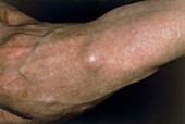 Ganglion on the forearm of a patient