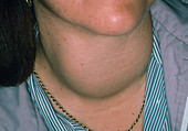 Swelling of neck due to Thyrotoxic Goitre