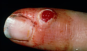 Pyogenic granuloma on patient's finger