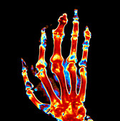 Coloured X-ray of a hand with gout