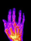 Coloured X-ray of a gout sufferer's hand