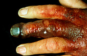 Close-up of gangrene of infected fingers