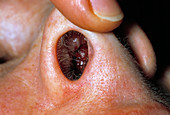 Granuloma in a nose