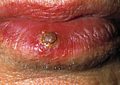 Granuloma on a lip