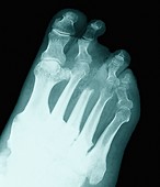 Gouty foot,X-ray