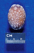 Gallstone