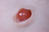 Umbilical scar