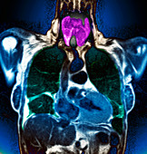 Swollen thyroid gland,MRI scan