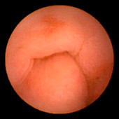 Gastric erosion,pill camera view