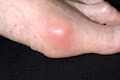 Gout joint inflammation