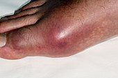 Gout of the big toe joint