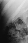 Gallstones,X-ray