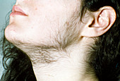 Young woman with hirsutism