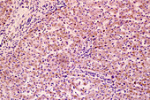 Liver cells affected by haemosiderosis