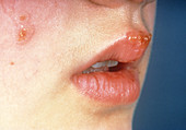 Herpes simplex cold sores on young woman's lip
