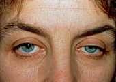 Horner's syndrome: ptosis & constricted pupil
