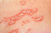 Herpes simplex lesions