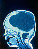 MRI scan of infant with holoprosencephaly
