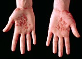 Cutaneous herpes simplex rash on hand