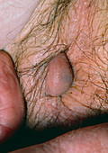 Thrombosed haemorrhoid (pile) obscuring anus