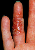 Herpes infection causing blisters on fingers