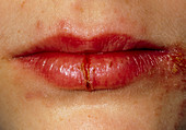 Cracked lips of girl affected by Herpes simplex