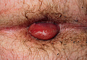 Thrombosed external haemorrhoid (pile) on anus