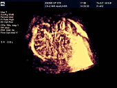 Liver tumour,3-D Doppler ultrasound
